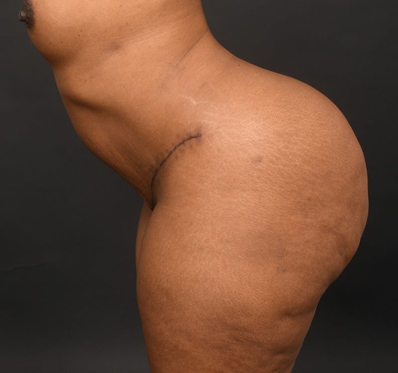 Tummy Tuck Before & After Gallery - Patient 165909 - Image 8
