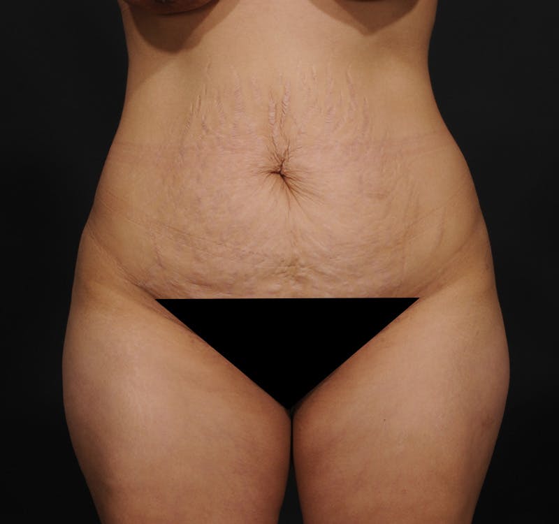Tummy Tuck Before & After Gallery - Patient 215762 - Image 1