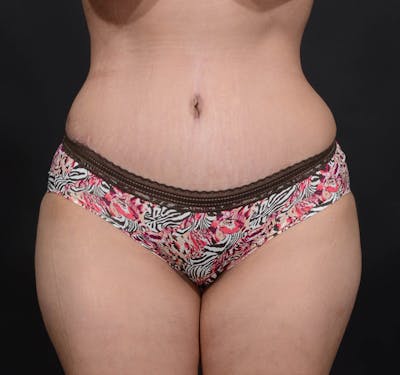 Tummy Tuck Before & After Gallery - Patient 215762 - Image 2