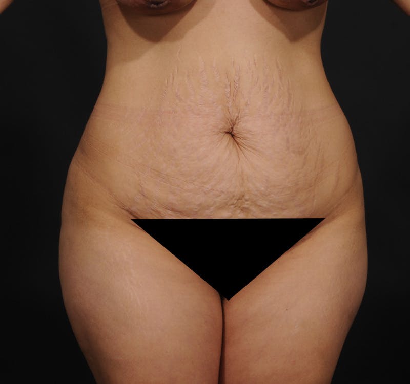 Tummy Tuck Before & After Gallery - Patient 215762 - Image 3