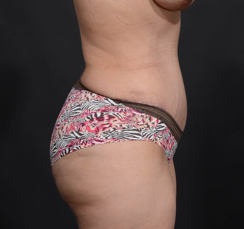 Tummy Tuck Before & After Gallery - Patient 215762 - Image 6