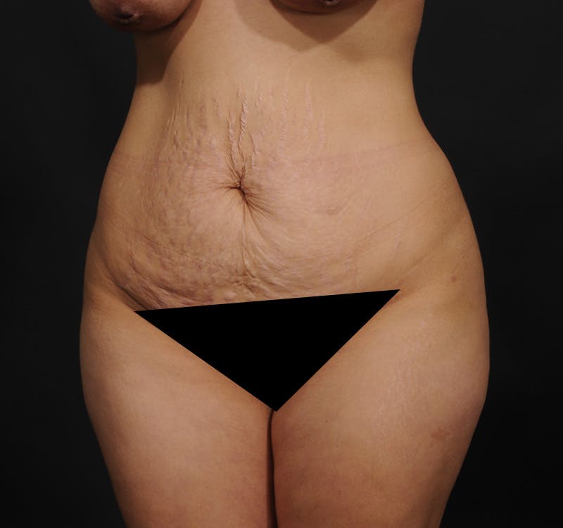 Tummy Tuck Before & After Gallery - Patient 215762 - Image 7