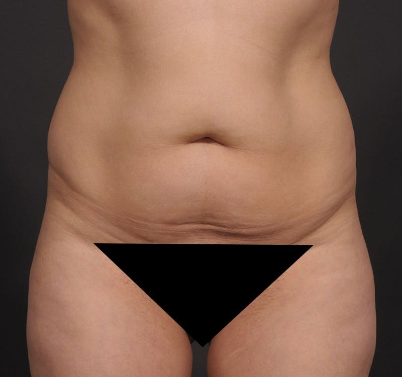 Liposuction Before & After Gallery - Patient 416364 - Image 1