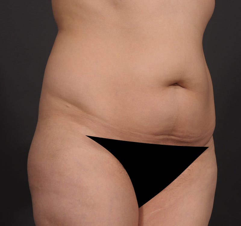 Liposuction Before & After Gallery - Patient 416364 - Image 3