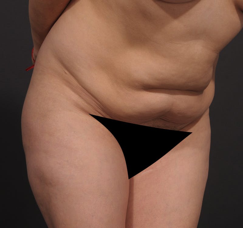 Liposuction Before & After Gallery - Patient 416364 - Image 5