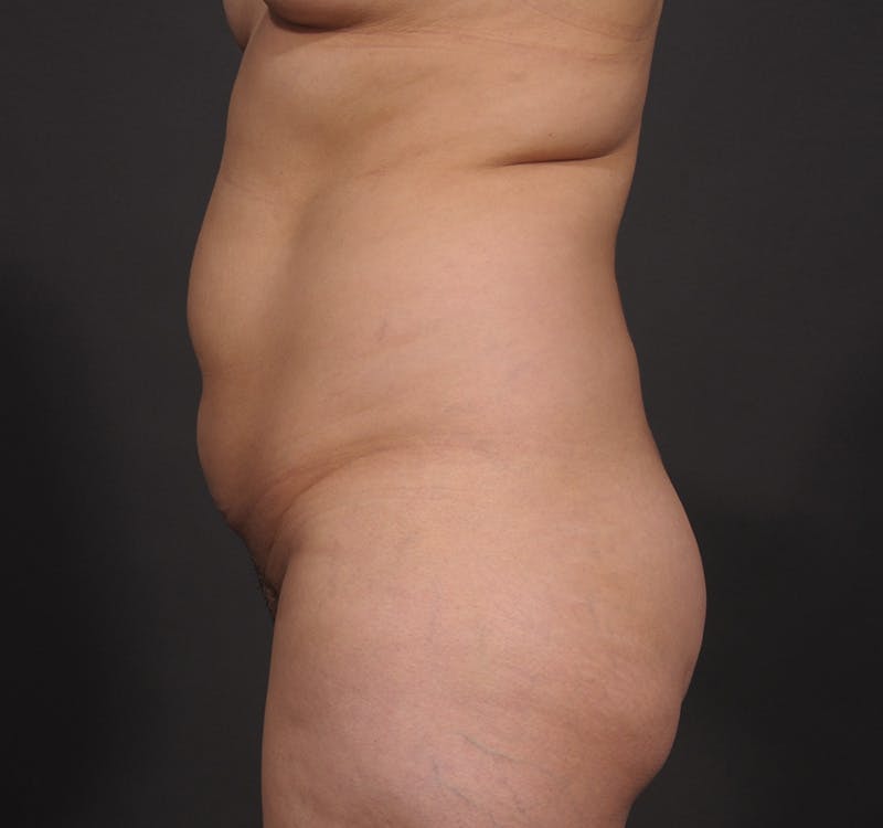 Liposuction Before & After Gallery - Patient 416364 - Image 11