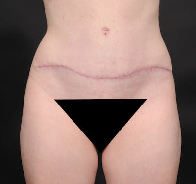 Tummy Tuck Before & After Gallery - Patient 394712 - Image 2