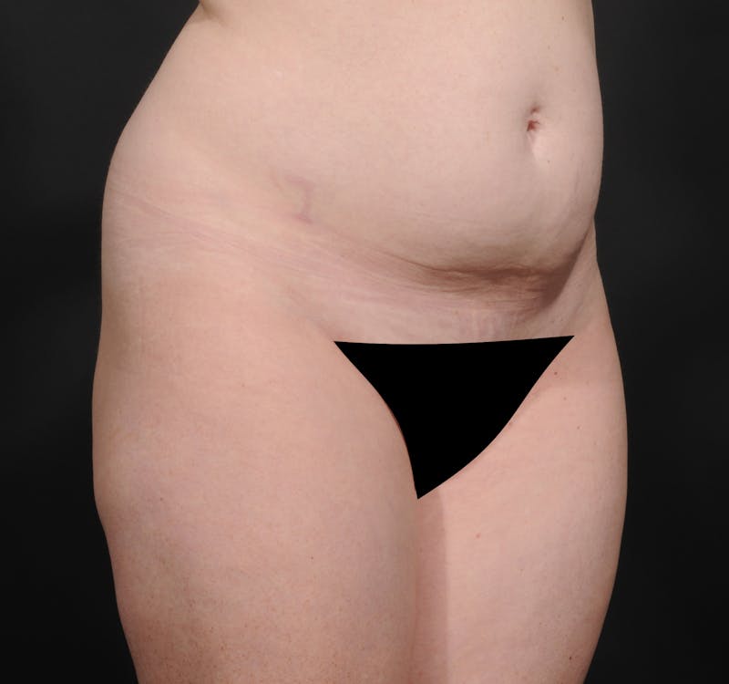 Tummy Tuck Before & After Gallery - Patient 394712 - Image 3