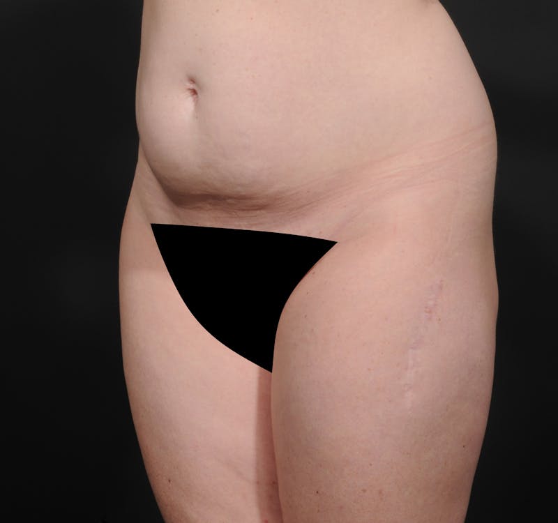 Tummy Tuck Before & After Gallery - Patient 394712 - Image 5