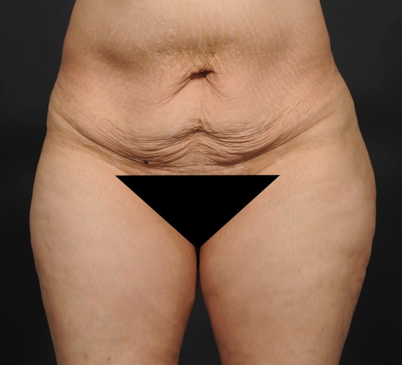 Tummy Tuck Before & After Gallery - Patient 399647 - Image 1