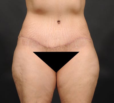 Tummy Tuck Before & After Gallery - Patient 399647 - Image 2