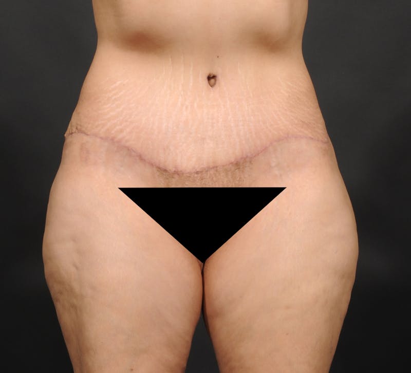 Tummy Tuck Before & After Gallery - Patient 399647 - Image 2