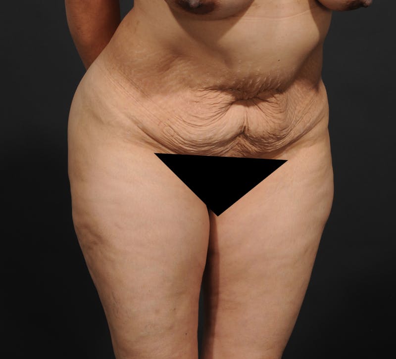 Tummy Tuck Before & After Gallery - Patient 399647 - Image 3