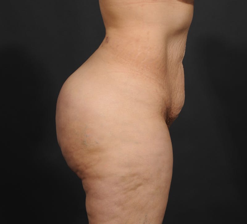 Tummy Tuck Before & After Gallery - Patient 399647 - Image 5