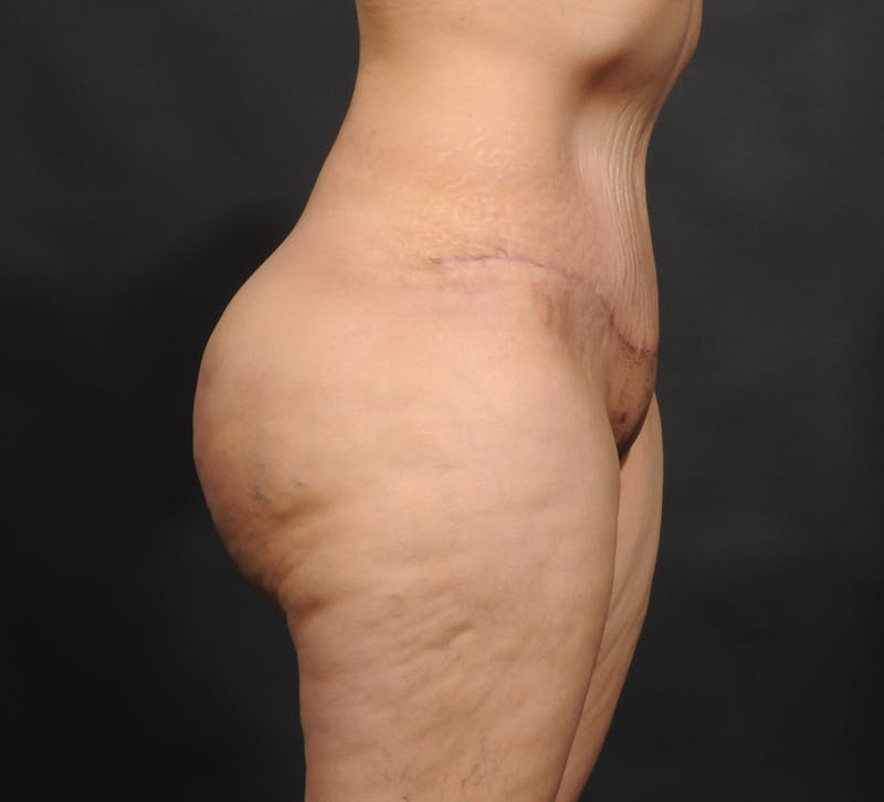 Tummy Tuck Before & After Gallery - Patient 399647 - Image 6