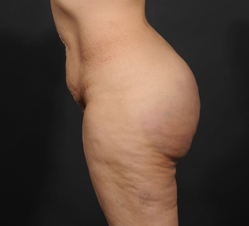 Tummy Tuck Before & After Gallery - Patient 399647 - Image 7
