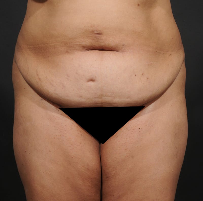 Tummy Tuck Before & After Gallery - Patient 348448 - Image 1