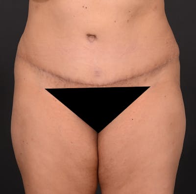 Tummy Tuck Before & After Gallery - Patient 348448 - Image 2