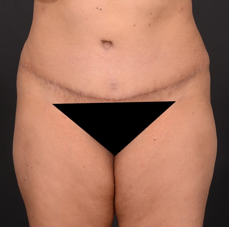 Tummy Tuck Before & After Gallery - Patient 348448 - Image 2