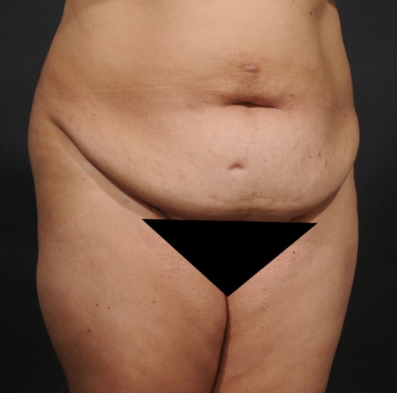 Tummy Tuck Before & After Gallery - Patient 348448 - Image 3