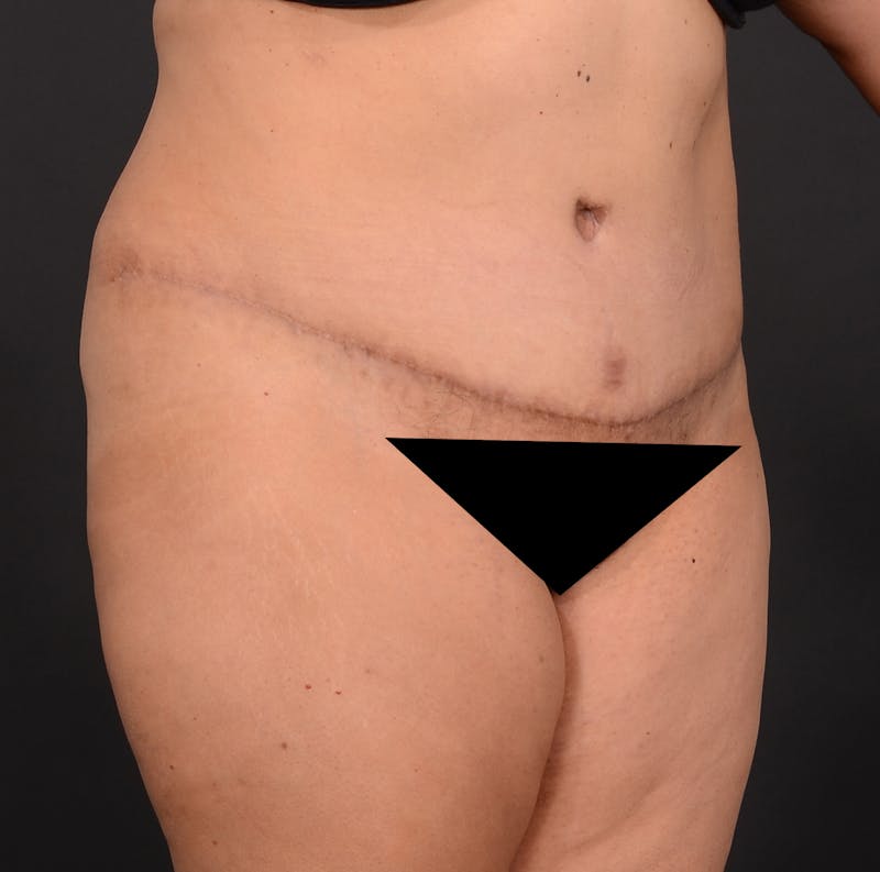 Tummy Tuck Before & After Gallery - Patient 348448 - Image 4