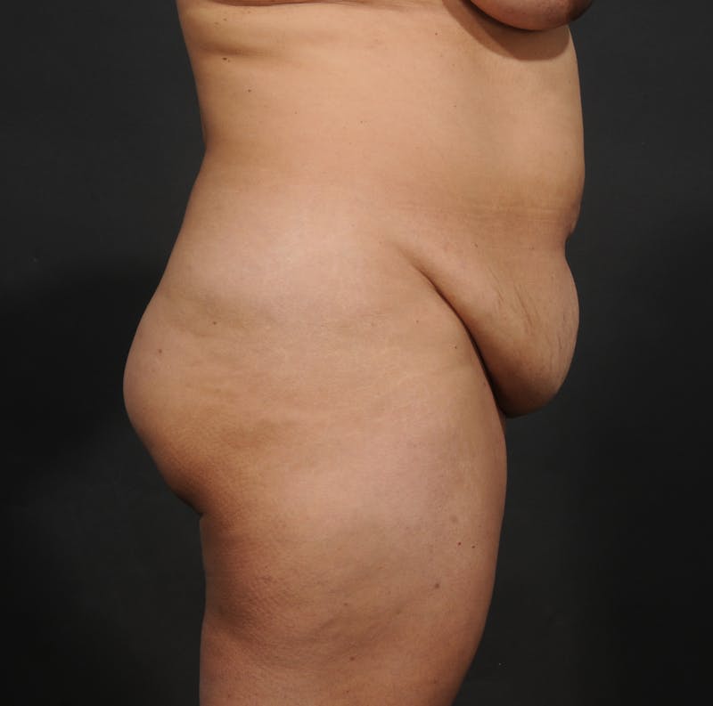 Tummy Tuck Before & After Gallery - Patient 348448 - Image 5