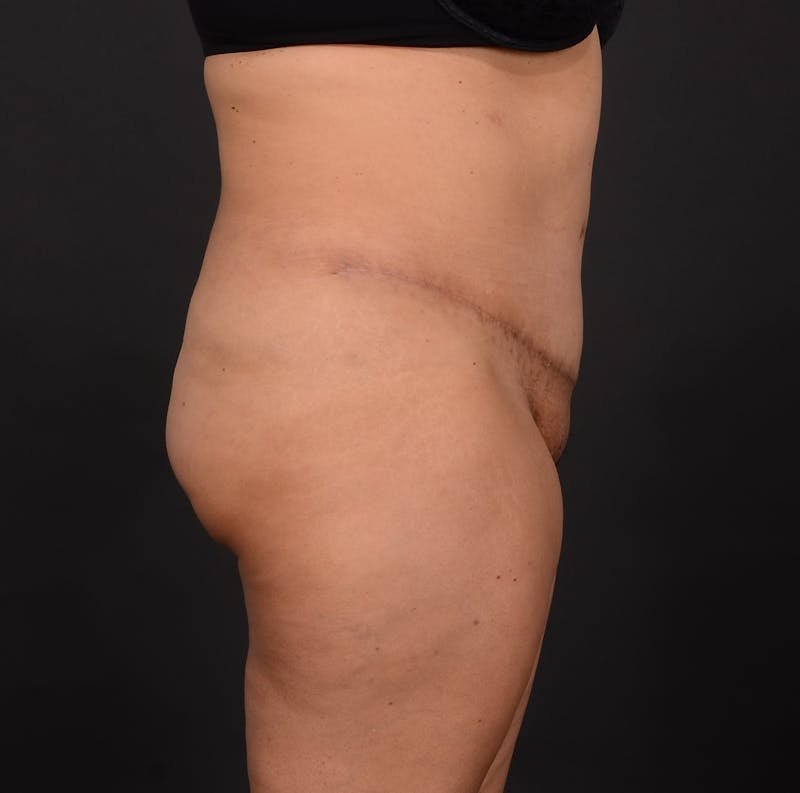 Tummy Tuck Before & After Gallery - Patient 348448 - Image 6