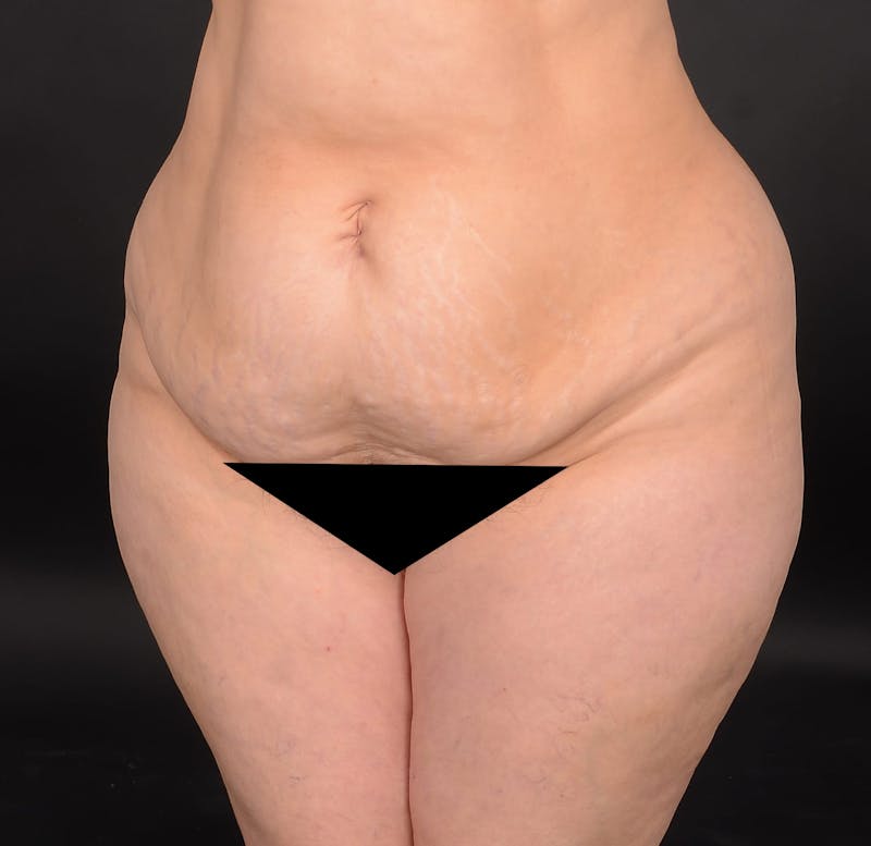 Tummy Tuck Before & After Gallery - Patient 414125 - Image 1