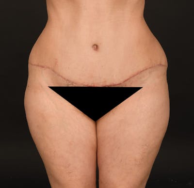Tummy Tuck Before & After Gallery - Patient 414125 - Image 2
