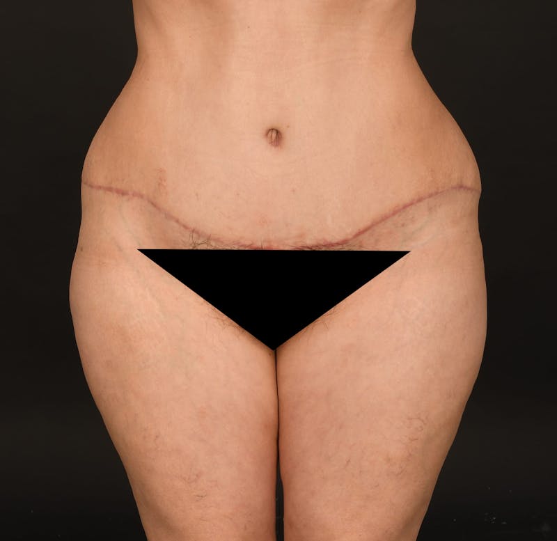 Tummy Tuck Before & After Gallery - Patient 414125 - Image 2