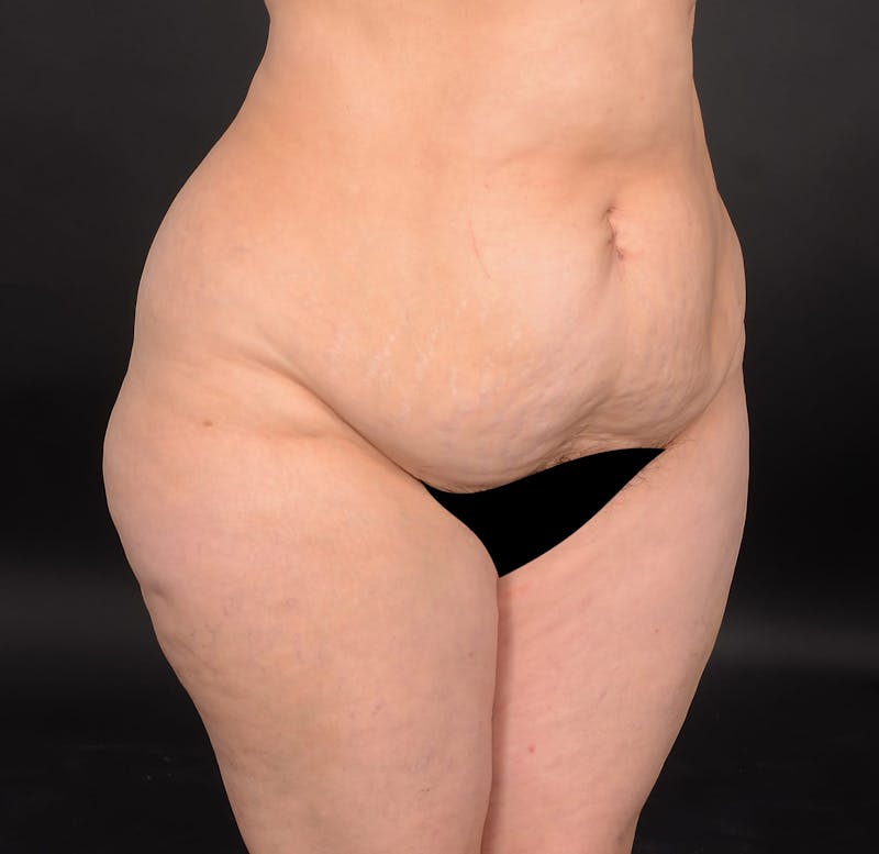 Tummy Tuck Before & After Gallery - Patient 414125 - Image 3