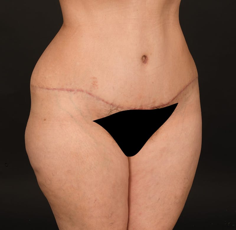 Tummy Tuck Before & After Gallery - Patient 414125 - Image 4