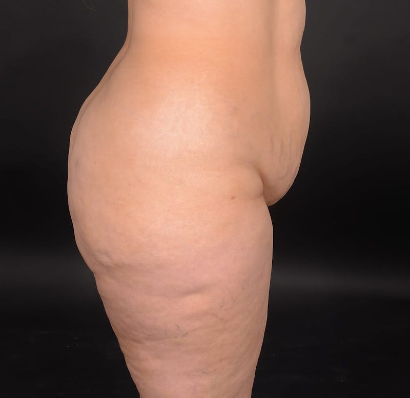 Tummy Tuck Before & After Gallery - Patient 414125 - Image 5
