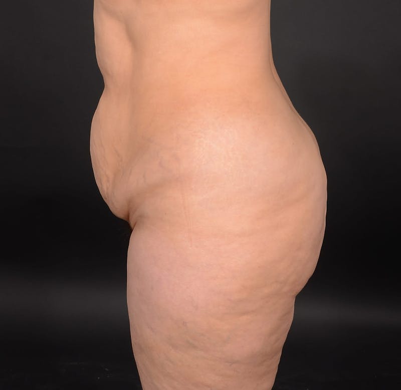 Tummy Tuck Before & After Gallery - Patient 414125 - Image 7