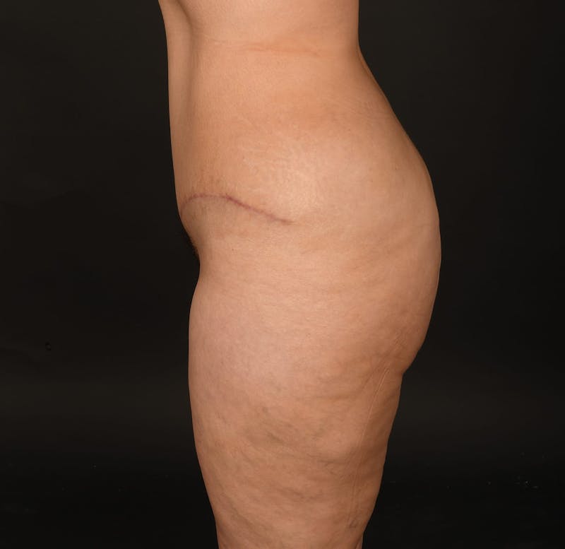 Tummy Tuck Before & After Gallery - Patient 414125 - Image 8