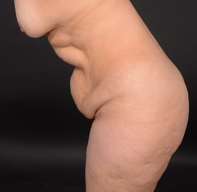 Tummy Tuck Before & After Gallery - Patient 414125 - Image 9