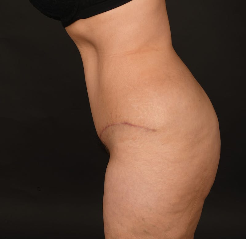 Tummy Tuck Before & After Gallery - Patient 414125 - Image 10