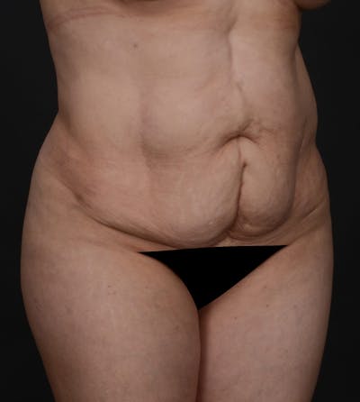 Tummy Tuck Before & After Gallery - Patient 217658 - Image 1