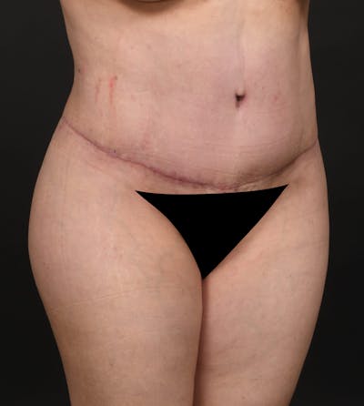 Tummy Tuck Before & After Gallery - Patient 217658 - Image 2