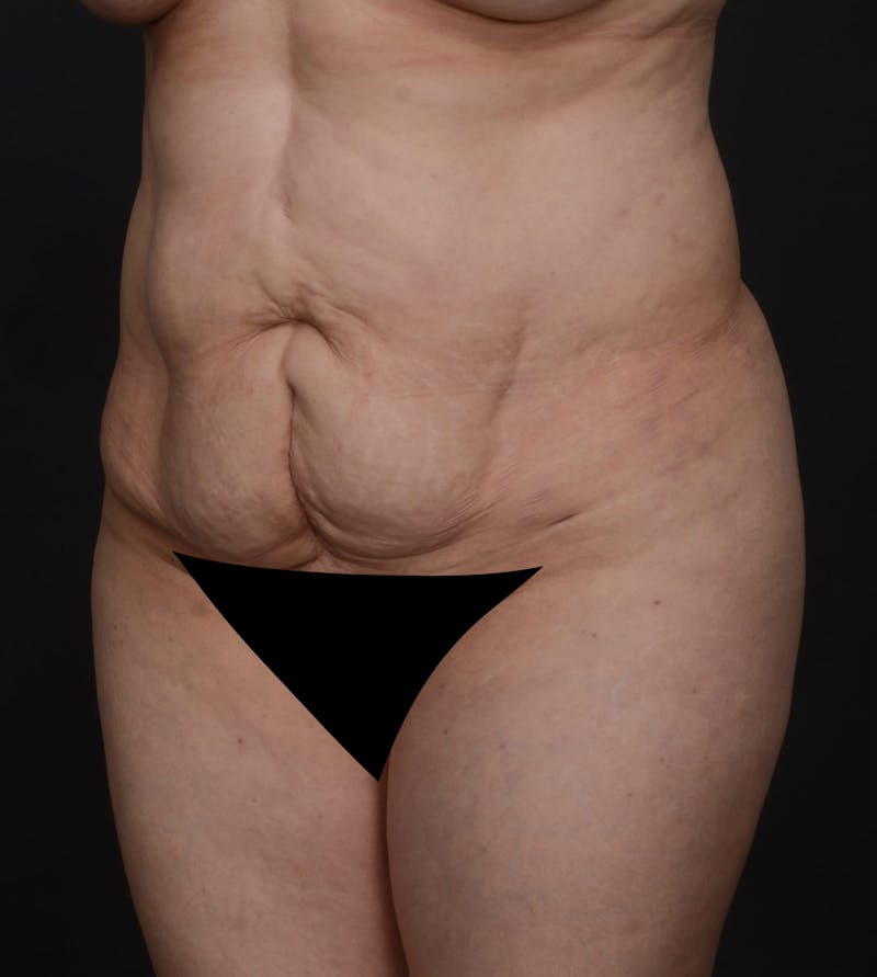 Tummy Tuck Before & After Gallery - Patient 217658 - Image 3