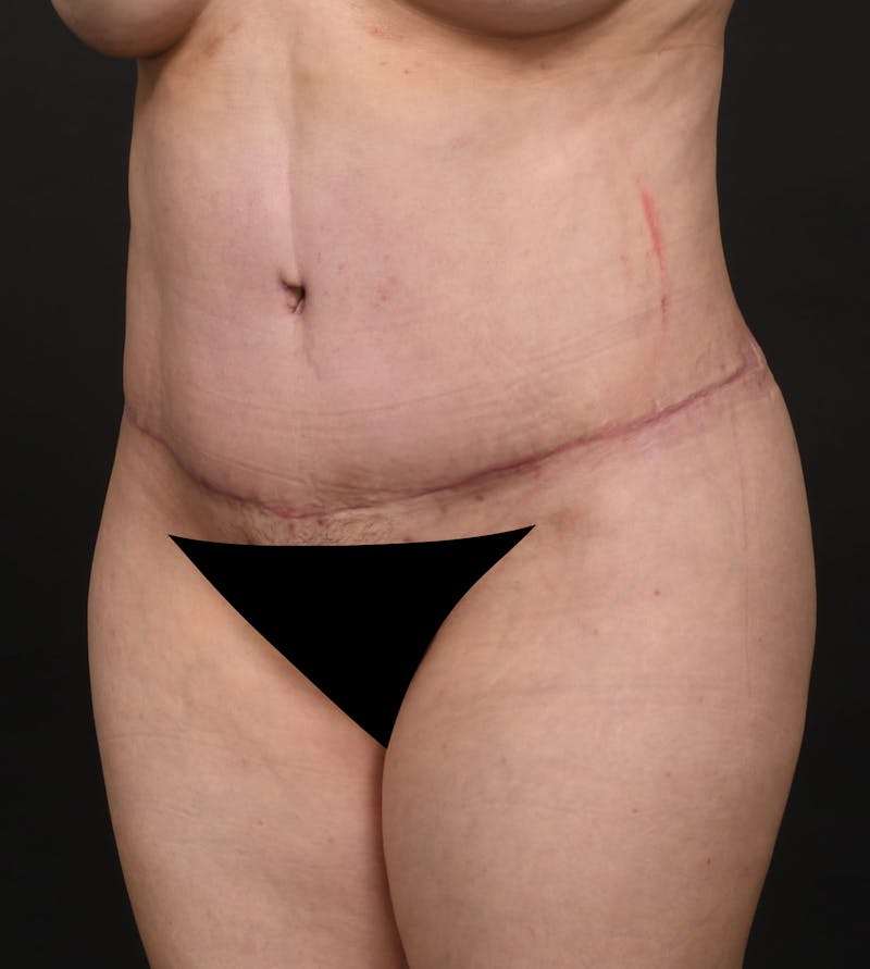 Tummy Tuck Before & After Gallery - Patient 217658 - Image 4