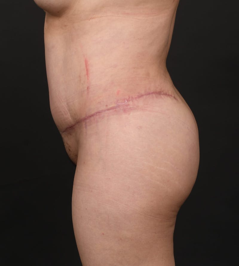 Tummy Tuck Before & After Gallery - Patient 217658 - Image 6
