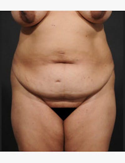 Tummy Tuck Before & After Gallery - Patient 406060 - Image 1