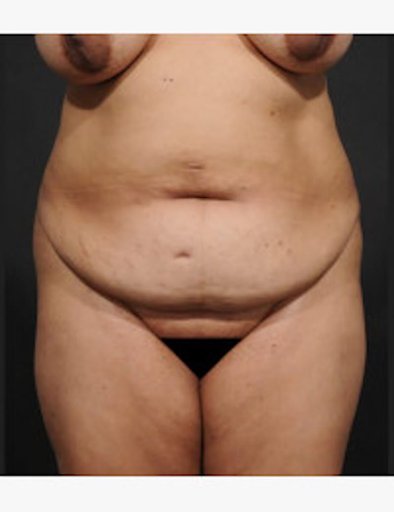 Tummy Tuck Before & After Gallery - Patient 406060 - Image 1