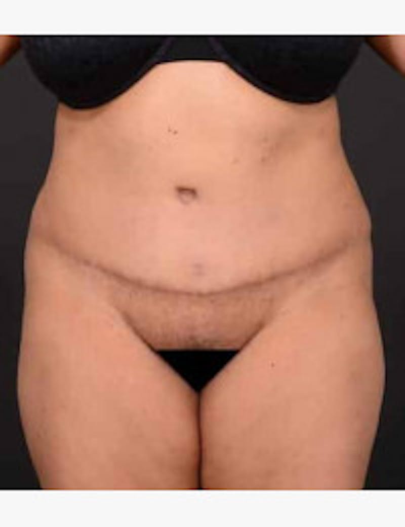 Tummy Tuck Before & After Gallery - Patient 406060 - Image 2