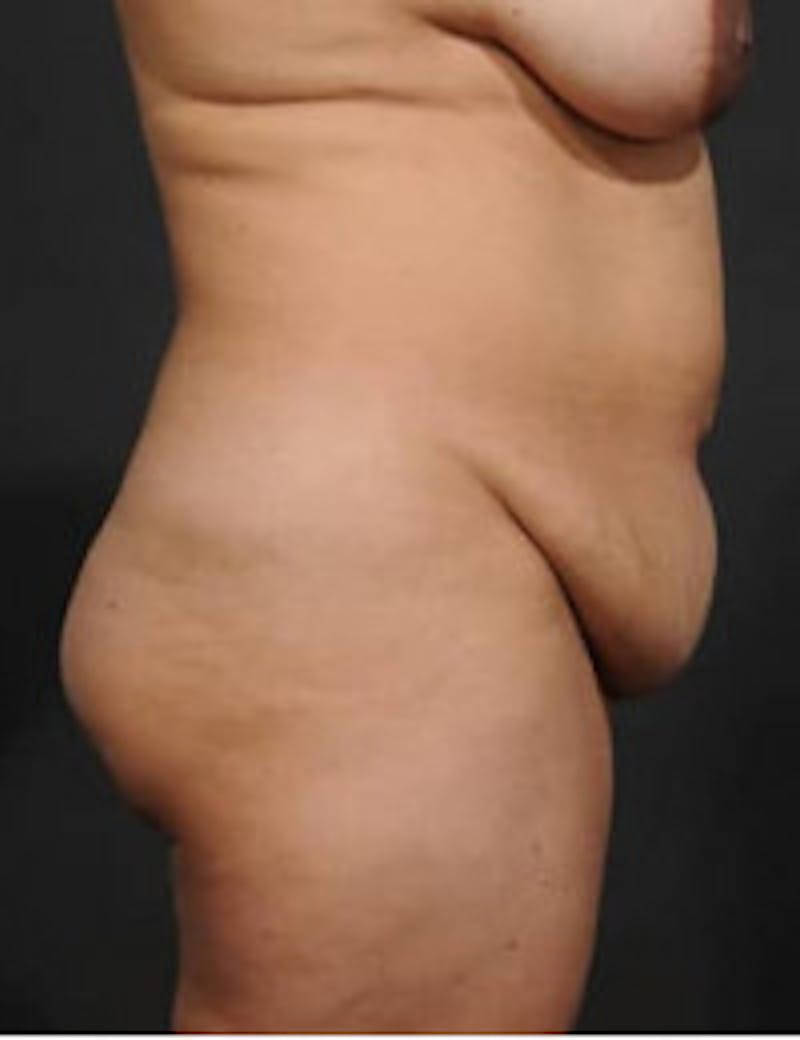 Tummy Tuck Before & After Gallery - Patient 406060 - Image 3