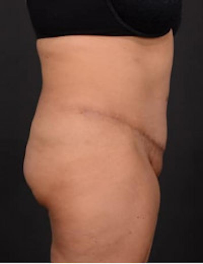 Tummy Tuck Before & After Gallery - Patient 406060 - Image 4