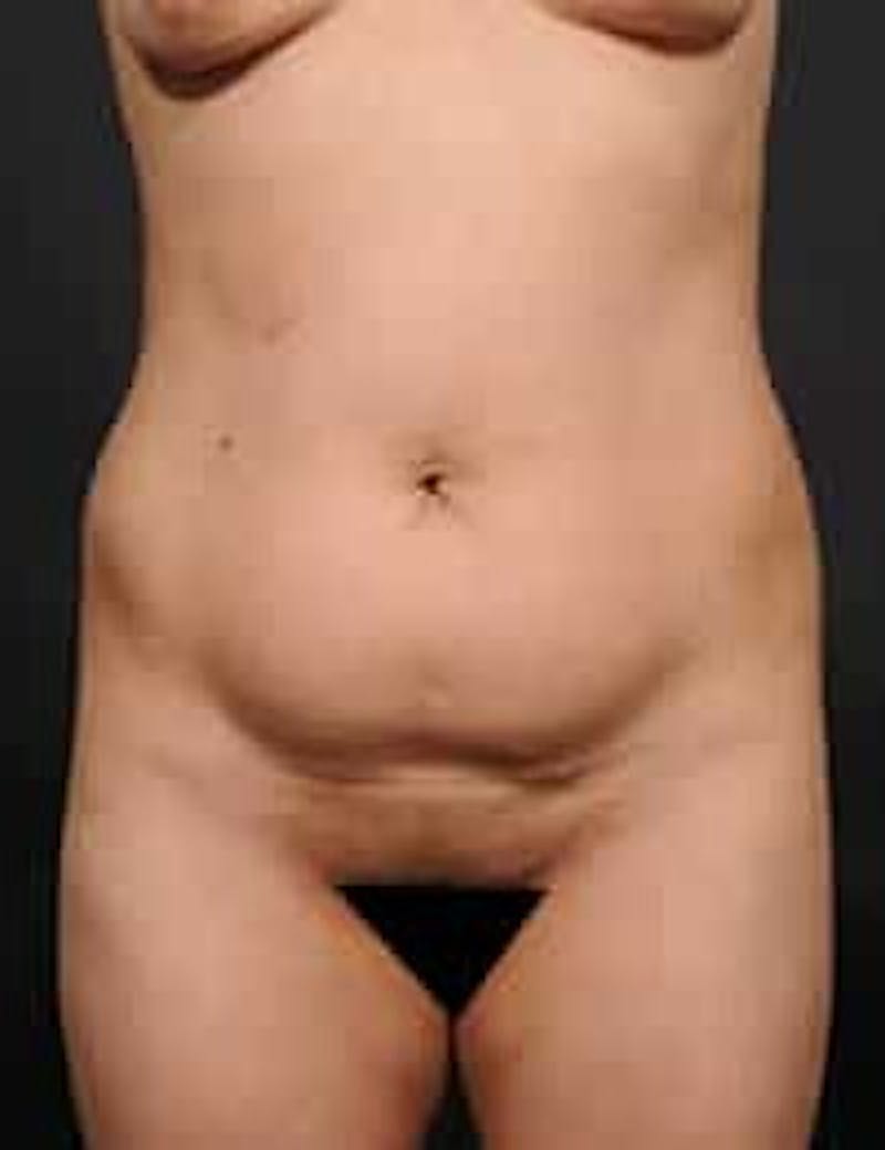 Tummy Tuck Before & After Gallery - Patient 211523 - Image 1