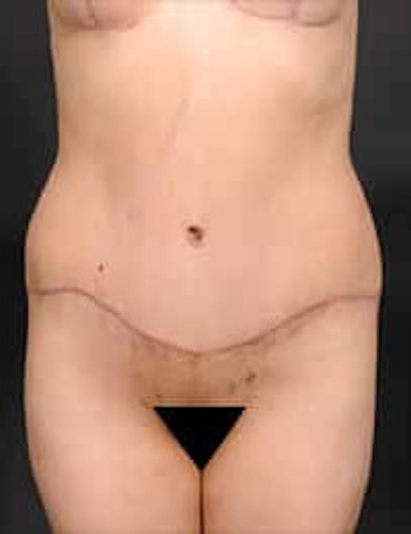 Tummy Tuck Before & After Gallery - Patient 211523 - Image 2