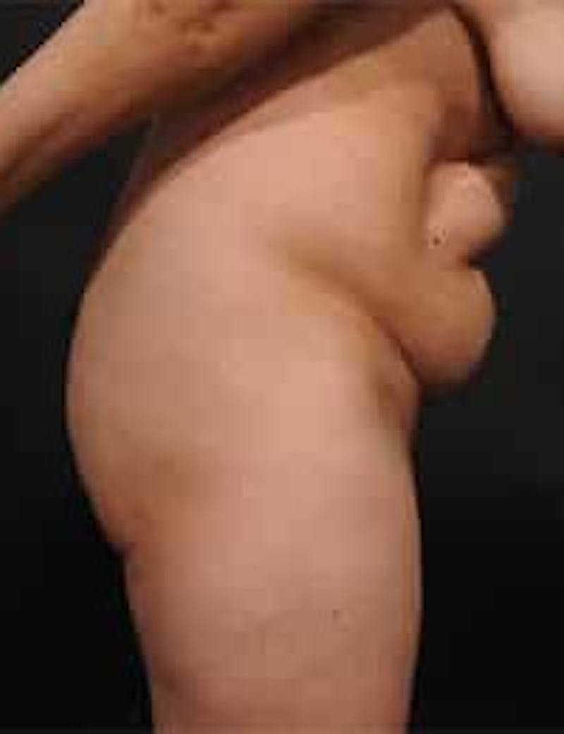 Tummy Tuck Before & After Gallery - Patient 211523 - Image 3
